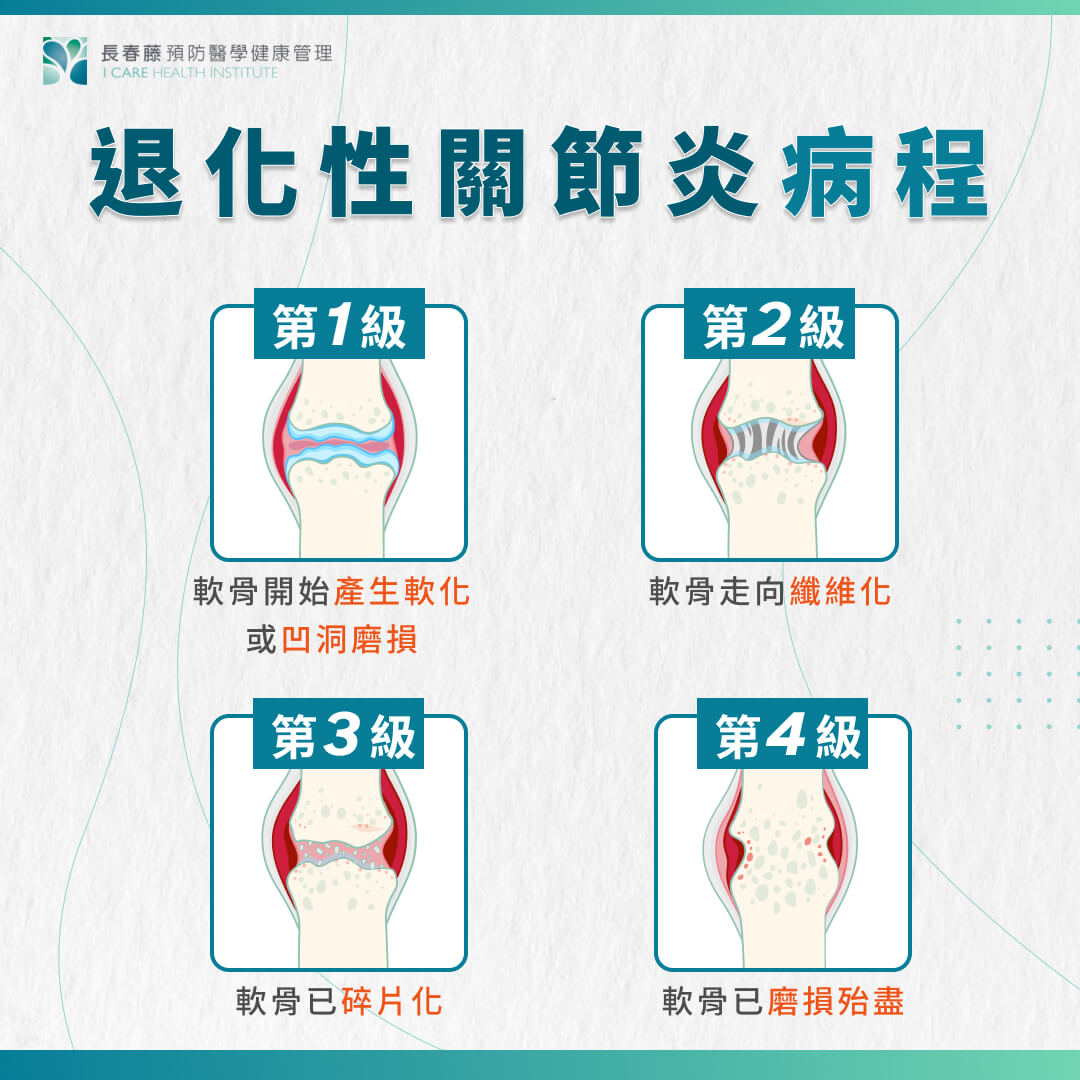 退化性關節炎病程